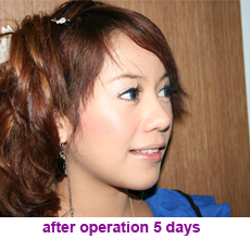 plastic-surgery-chin-augmentation